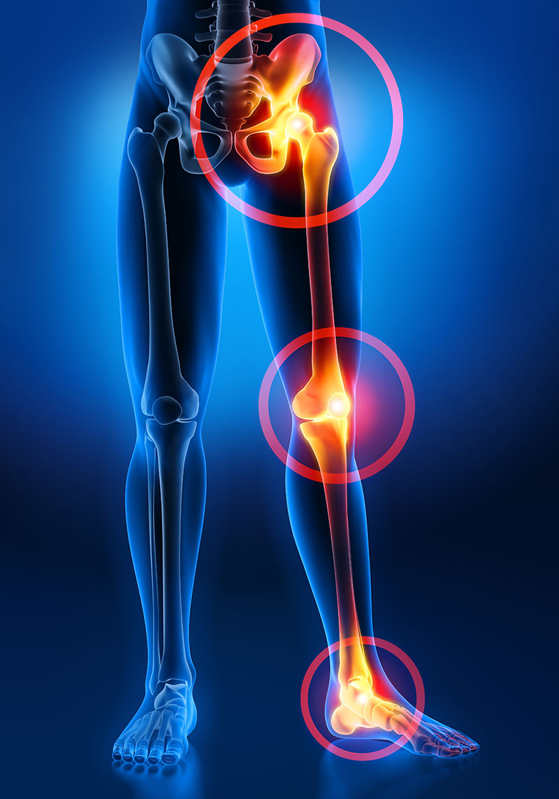 Arthritis bei Morbus Bechterew Arthritis bei Morbus Bechterew